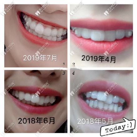 回憶自己門牙重疊錯位,在重慶戴時代天使隱形牙套矯正效果