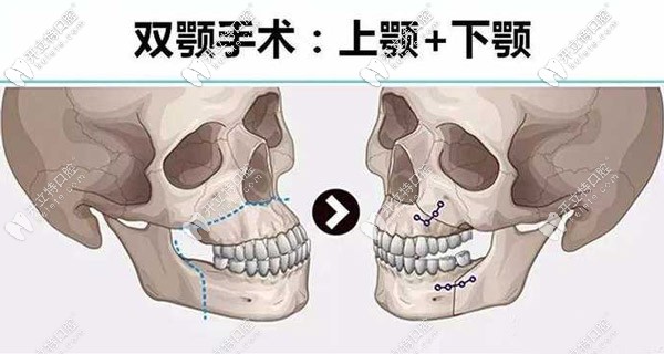 <!--<i data=20240703-sp></i>-->做骨性地包天矯正的費(fèi)用是多少？