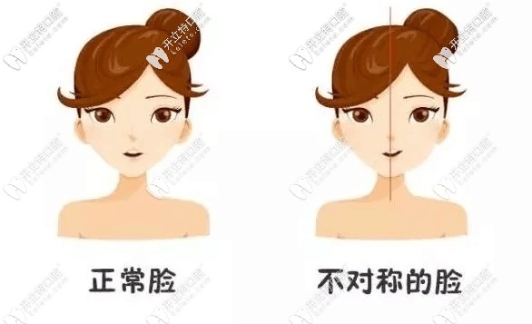 單側(cè)咀嚼的危害不僅導致下頜骨不對稱,且歪臉不一定能恢復