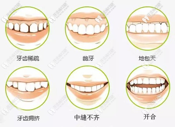珠海牙齒矯正價(jià)格表送你啦，里面有在珠海帶牙套的費(fèi)用哦