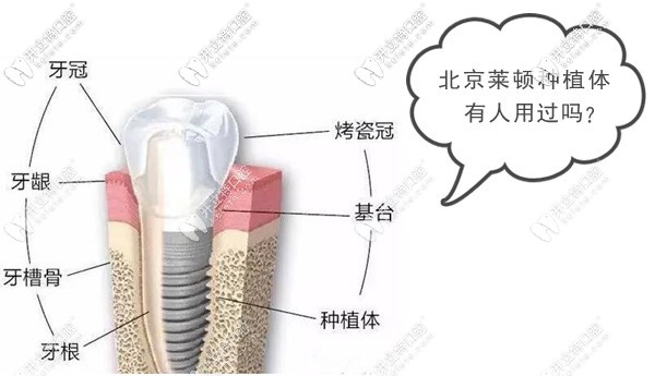 北京萊頓種植體有人用過嗎?聽說這是國(guó)產(chǎn)種植牙主流品牌
