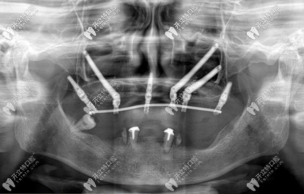 關(guān)于穿顴骨穿翼板種植牙要多少錢,參考價(jià)格看完便知