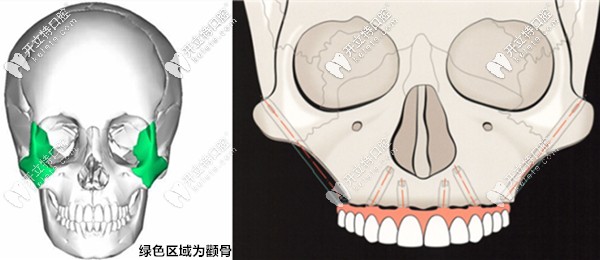 顴骨種植的示意圖