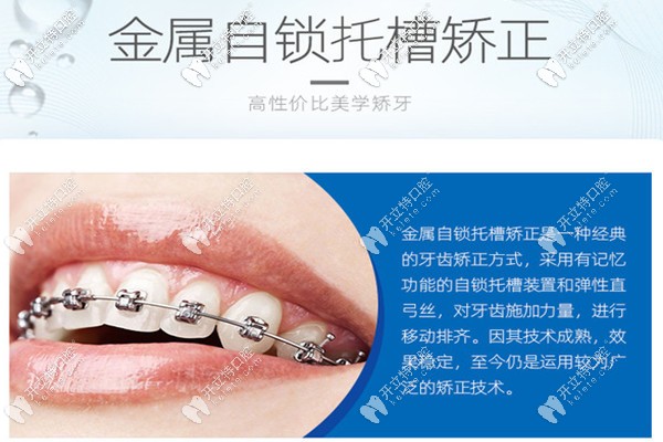 西安團(tuán)圓口腔自鎖托槽整牙技術(shù) 西安團(tuán)圓口腔自鎖托槽整牙技術(shù)