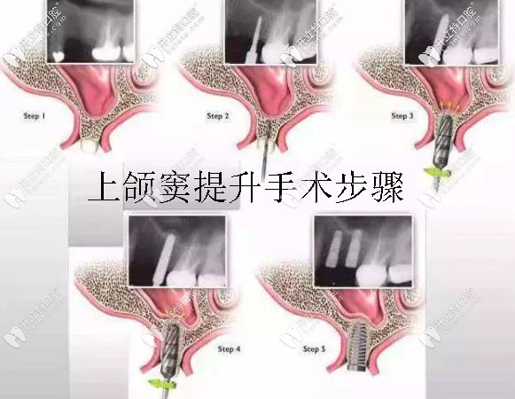 做上頜竇內(nèi)外提升手術(shù)的價格及恢復(fù)時間,這篇文章可告訴你