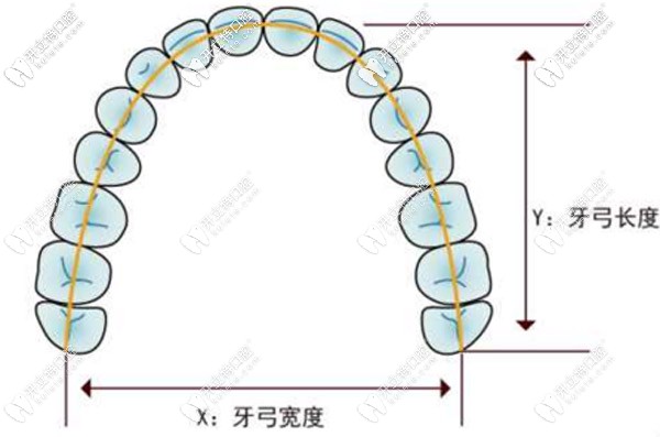 8-14歲的兒童使用牙齒擴弓的費用大概是多少？