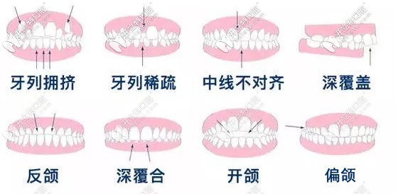  渭南牙科做牙齒矯正多少錢？想知道隱形和金屬矯正的價格