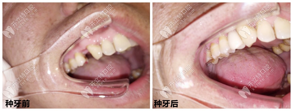 石家莊中諾口腔種牙好嗎？從種牙案例、醫(yī)生技術來看！