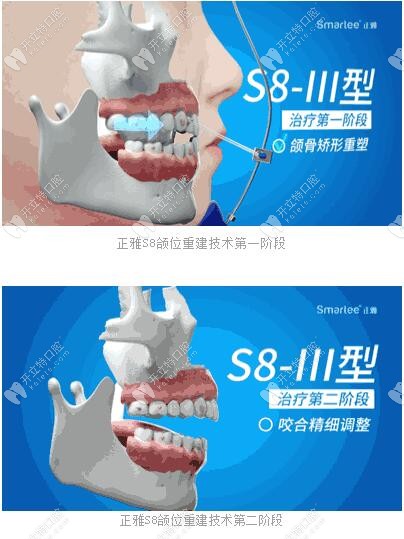 正雅S8、S9、S10頜位重建術(shù)